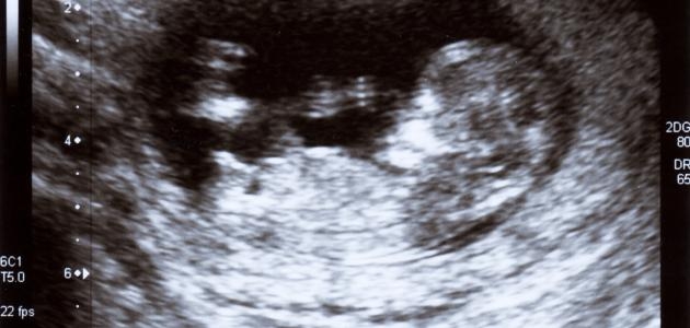 علامات وفاة الجنين في الشهر التاسع